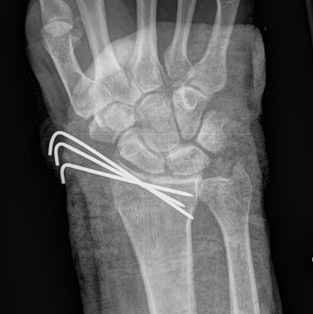 Radial Styloid K wires.jpg